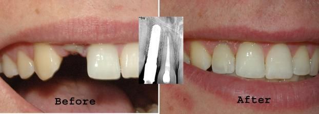 A picture of a missing tooth and then a perfect smile; an xray showing a dental implant is in the middle of the before and after images.